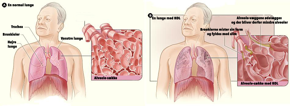 Asmatisk_brontitis