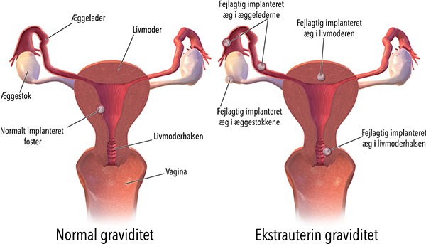 Graviditet udenfor livmoderen