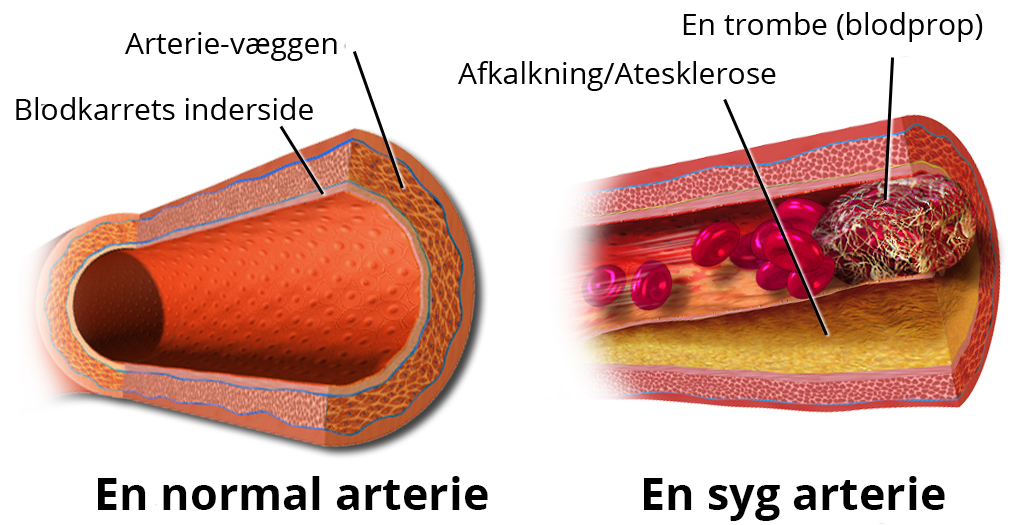 Aterosklerose